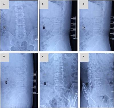 Sciatic Herpes Zoster Suspected of Lumbar Disc Herniation: An Infrequent Case Report and Literature Review